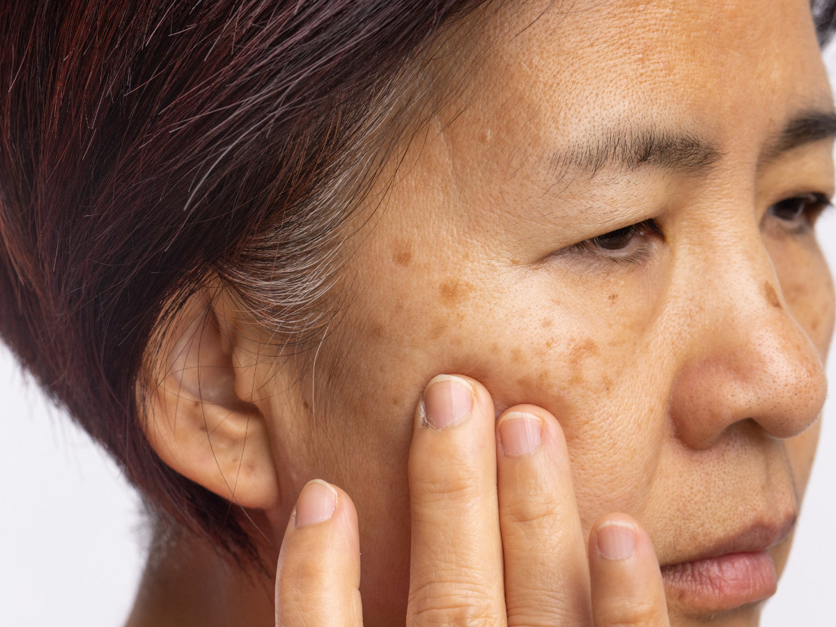 Melasma como identificar. Foto: mulher asiática com a mão no rosto mostrando a mancha na pele