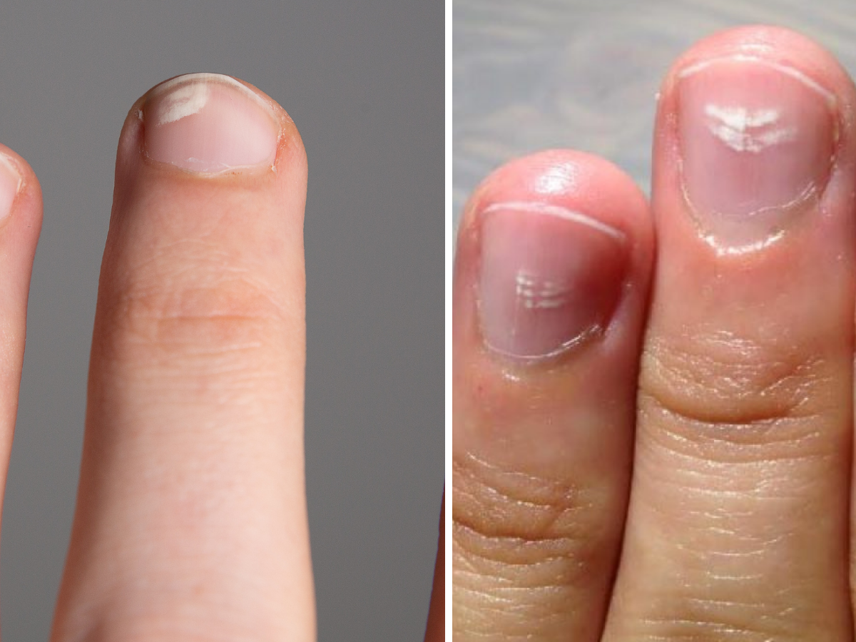 Unhas com manchas brancas ou listradas. Foto mostra dedos com as unhas das mãos com manchas brancas